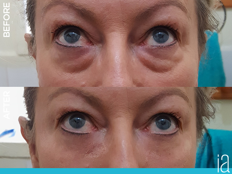 before and after proof of Instantly Ageless Cream by Jeunesse Global